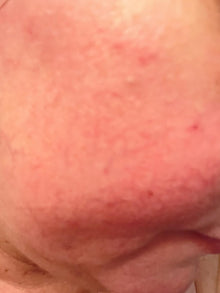 Before - Crema Hidratante para piel sensible y rosácea