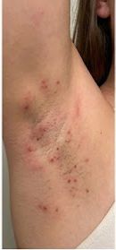 Before - Me encantó! Nunca habia sentido la piel tan hidratada después de depilarme, ya no me arde.